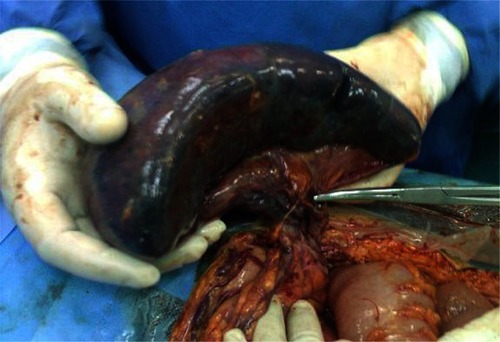 Figure 2 Torsioned spleen in laparotomy.