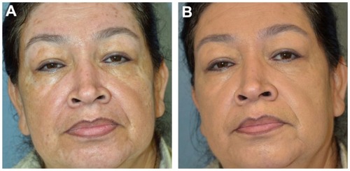 Figure 4 Patient with (A) visible depigmented patches on the face (B) without evidence of any skin changes after application of cosmetic camouflage prior to initiation of ultraviolet B therapy.