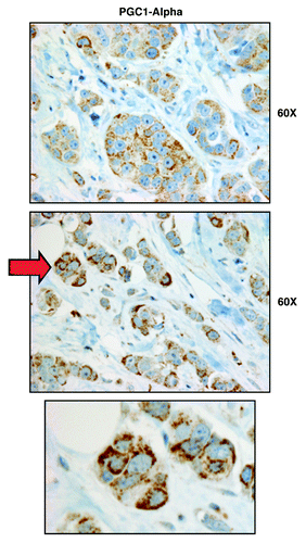 Figure 4. PGC1-α, a key mitochondrial transcription factor, is largely confined to epithelial cancer cells, and absent from stromal cells, in human breast cancers. Paraffin-embedded sections of human breast cancer primary tumors were immunostained with antibodies directed against PGC1-α. Note that PGC1-α immunostaining is largely confined to the epithelial cancer cells. A red arrow points at an area that is further magnified below and is shown as an inset. Original magnification, 60x.