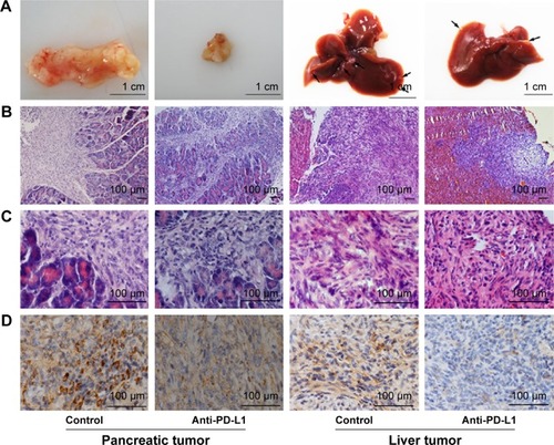 Figure 2 Immunohistochemical analysis of PD-L1 expression in pancreatic cancer tissue and spontaneous liver metastases.