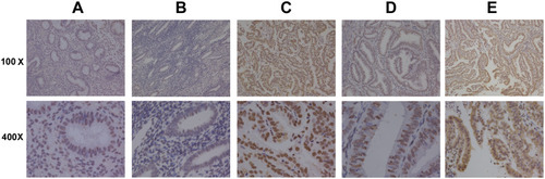 Figure 4 Immunohistochemical analysis of nucleolin expression in endometrioid endometrial adenocarcinoma and normal tissues.