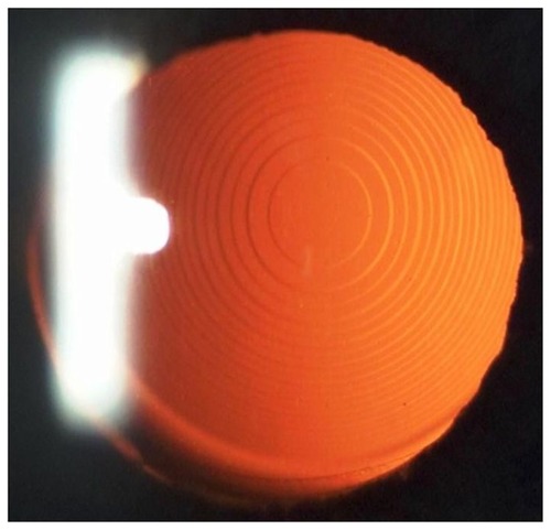 Figure 1 Slit lamp photograph of a patient eye implanted with the FineVision® intraocular lens.
