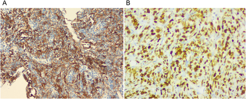 Figure 3 The presents representative immunohistochemical staining images of tissues. The cells exhibited positivity for CD21 (A) and Ki-67 (B). The original magnification of the image is 100×.