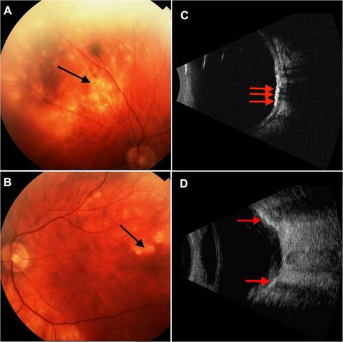 Figure 1 Fundus photography and B-scan ultrasonography of sclerochoroidal calcification lesions. (A) There are dense yellow-white lesions in the superotemporal region near the superior retinal arcades in the right eye. (B) Fundus photography shows scattered calcifications in the superotemporal region of the fundus in the left eye. (C and D) Ultrasonography in both eyes shows hyperechoic lesions at the level of the choroid-scleral junction with posterior shadowing.
