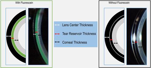 Figure 2 Schematic diagram and real photography of an optic section using fluorescein (left) and without fluorescein (right). The white arrows represent scleral lens thickness, the red arrows represent post-lens fluid reservoir thickness, and the black arrows represent corneal thickness.