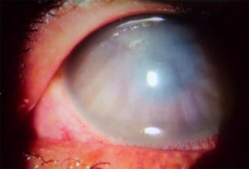 Figure 1 Subepithelial corneal edema, with deep stromal infiltration.