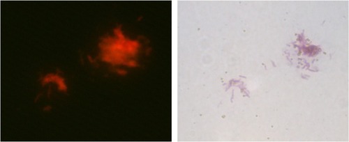 Figure 4 Microscopic observation of the sandwich complex of H37Rv bacterial cells, MMSs, and QDs (direct fluorescence observation 400× and Ziehl–Neelsen stain 1,000×).Abbreviations: MMSs, magnetic microspheres; QDs, quantum dots.