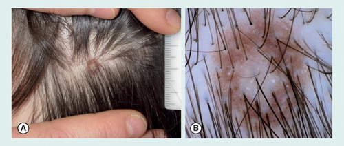 Figure 3. Eclipse nevus on the scalp of a 12-year-old boy.(A) Clinical view with presence of a white central area surrounded by a rim of brown pigmentation. (B) Under a dermoscope, the lesion shows a pigment network with perifollicular hypopigmentation, and scattered homogeneous brown globules. At the center, a hypopigmented, white area is detected.