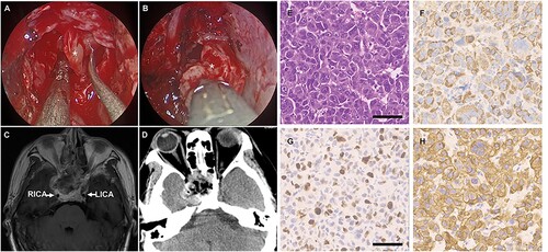Figure 2. Intraoperative snapshot and histological tumor specimens. (A, B) exhibited the tumor (*) was soft and with abundant blood supply. (C, D) Post-operative MRI indicated the mass effect of the tumor was resolved and the right ICA was returned to normal locality. (E) Hematoxylin and eosin staining of the pituitary tumor demonstrating a tumor without pituitary tissues. Immunohistochemical expression of (F) hepatocytes, (G) ki67, and (H) CK18. Bar: 60 μm.