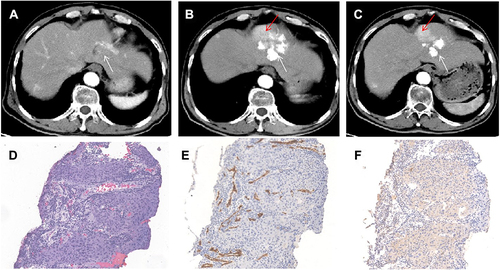 Figure 9 Images in a 66-year-old man (case 146) with S2 non-VETC, non-MTM, CK19-negative HCC, BCLC B stage and baseline serum AFP level of 24 ng/mL. (A), baseline HAP CT image showed a hyperenhanced HCC in the S2 liver lobe; (B), HAP CT after the first session of cTACE: defect and about 50% lipiodol deposition (white arrow), tumor response is PR according to mRECIST (alive lesion: red arrow); (C), HAP CT after the second session of cTACE: lipiodol deposition was not increased in alive lesion (red arrow); (D), HE of HCC showed tumor cells were distributed in flakes with a large number of lymphocytes infiltration; (E), HCC was non-VETC according to CD34 IHC; (F), CK19 was negative (×40 magnification).