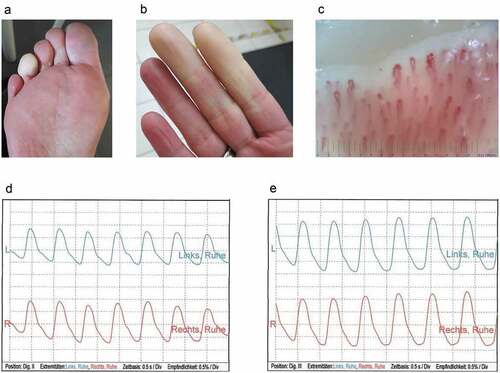 Figure 1. Representative female participant with new onset of Raynaud´s phenomenon after COVID-19 vaccination. a. Well-demarcated, white-pale, cold fourth toe of the right foot. b. Affected index and third finger of the right hand with sharp demarcation of skin pallor. c. Nailfold capillaroscopic image of the affected third finger of the right hand, showing dilatation, torsion and reduced capillary density, but lack of megacapillaries. d and e. Optical pulse oscillograms of the index (d) and the third finger (e) of the affected right hand (red) and the unaffected left hand (blue-green) revealing regular oscillations.