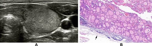 Figure 6 Follicular thyroid adenoma of the left thyroid in a 41-year-old female. (A) Transverse sonogram indicates a nodule with a thin and relatively regular halo. (B) Photomicrograph shows a thin capsule (arrow) and normo-follicular growth pattern can be observed (H and E, × 100).
