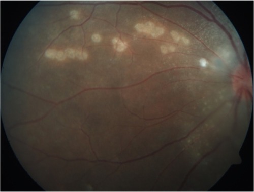 Figure 3 Left fundus showed resolution of crops of choroidal lesions with multiple focal laser scars nasal to the optic disc at 1 week posttreatment.