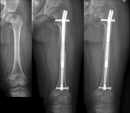 Figure 4 A 12-year-old girl with achondroplasia. She underwent consecutive 50 mm lengthenings of both femurs with the shortest available Precice nail (16.5 cm). Radiographs preoperatively (a), when lengthening was completed (b) and after consolidation (c). The nail has only one locking option proximally and distally to allow for 50 mm lengthening, despite the shortness of the nail. The patient’s femurs had not been lengthened earlier. Lengthening indices for both femurs were 0.6 months/cm, the fastest healing of all procedures included in the current study.