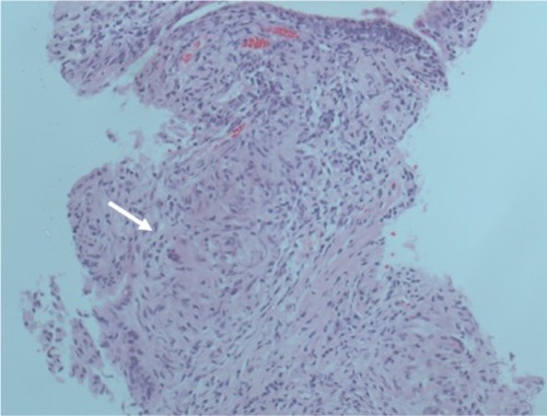 Figure 3 Light microscopy examination of the needle core prostatic biopsy showing multiple necrotizing granulomata with giant cells (white arrow), high suspicion of infective etiology; in particular mycobacterium bacteria.
