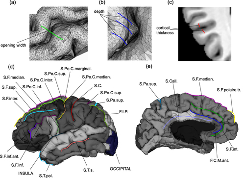 Figure 1 Illustration of the sulcal parameters and labelling of cortical sulci of interest. (a) opening width (green); (b) The mean depth is the average of the depth across all bottom points (blue); (c) cortical thickness (red); (d) the lateral view of sulcal labels; (e) the medial view of sulcal labels.