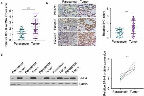 Figure 1. B7-H4 expression is elevated in CRC tissues. A. B7-H4 mRNA expression levels was detected in a total of 80 pairs of CRC tissues and adjacent normal tissues by RT-qPCR. B. The expression levels of B7-H4 in 80 pairs of CRC tissues and adjacent tissues were evaluated by immunohistostaining (IHC). Images showed the examples of IHC staining in 3 paired tissues. Scale bar: 100 μm. C. The expression levels of B7-H4 in 5 pairs of CRC tissues and adjacent normal tissues were analyzed by Western blot. **, P < 0.01, and ***, P < 0.001. The error bars are defined as S.D