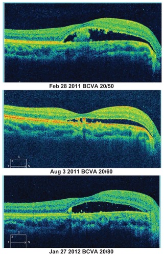 Figure 2 Observed patient with variable subretinal fluid over 1 year.(Patient 3, Table 2)