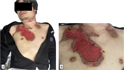 Figure 1 A 3×5 cm erythematous plaque with ulceration and friable granulation tissue was presented in the chest region. Other 1×2 cm erythematous nodules and plaques with sinus tracts were visible in the neck and chest region (a and b).