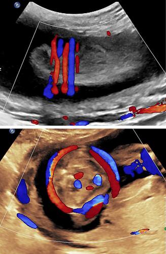 Figure 1 Mid-trimester axial image of the fetal body. Note two loops of cord around the lower fetal abdomen. Upper panel: Axial image. Lower panel: Sagittal image.