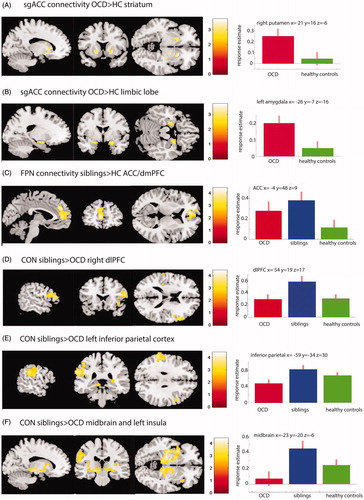 Figure 2. Group differences in network to whole-brain connectivity. (A and B) Areas with increased connectivity with the sgACC in OCD (n = 39) compared with healthy controls (n = 36). In (A) results are masked for the striatum and in (B) for the limbic lobe for illustration purpose and displayed at P < 0.005 uncorrected. (C) Increased connectivity between the FPN and the dACC/dmPFC in siblings vs healthy controls. (D, E, F) Increased connectivity in siblings vs OCD patients between the CON and the right dlPFC (D), the left inferior parietal cortex (E), and the midbrain areas, extending into the insular cortex (F). Plots on the right side show the response estimates for each group at the given coordinates.