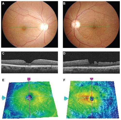 Figure 1 Color fundus photographs and Cirrus OCT images of an 82-year-old woman who underwent vitrectomy with and without ILM peeling for bilateral macular holes.