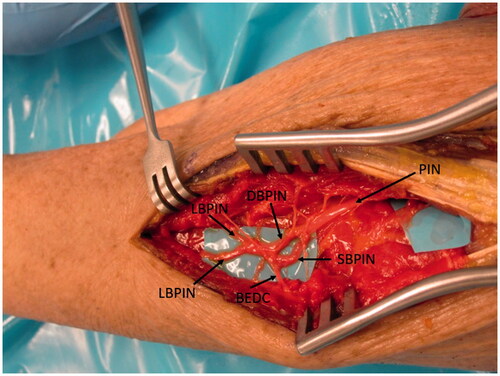 Figure 1. The PIN is followed distally where it branches into the deep (DBPIN) and superficial (SBPIN) branches of PIN. The DBPIN then divides into medial (MBPIN) and lateral (LBPIN) branches. The branch to EDC (BEDC) is also shown.