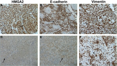 Figure 1 Immunohistochemistry staining for HMGA2, E-cadherin, and vimentin in human nasopharyngeal carcinoma specimens.