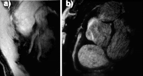 Figure 2. Cardiac-gated spiral images (cropped) w/90 interleaves, 0.7 mm resolution and 24 cm FOV. (a) Left Anterior Descending Artery (LAD), (b) RCA after the DVA has converged.