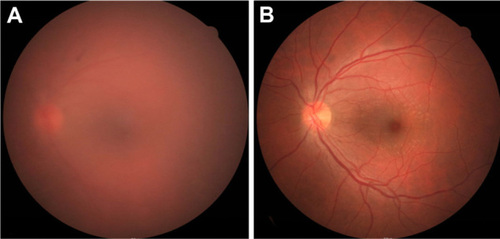 Figure 3 Fundus photography 3 days and 1 month after the operation. (A) Three days after the operation, fundus photography shows vitreous haziness due to inflammation. (B) Inflammation was resolved at 1 month after the operation.