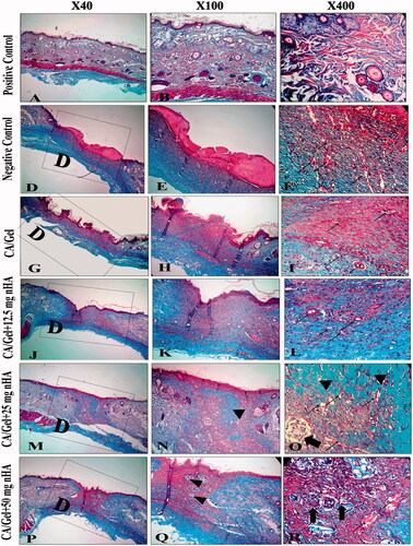 Figure 6. Masson’s trichrome (MT stained) microscopic sections of healed incisions in rats at 14 d. D: defect; positive control: normal skin; negative control: sterile gauze-treated wound; thick arrow in R: hair follicle; thick arrows in O: multinucleated giant cells; arrowheads in Q and R: collagen deposition; arrowheads in N: foreign body reaction; thin arrows: angiogenesis.