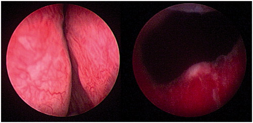 Figure 3. 80CC prostate pre- and post-UroLift.