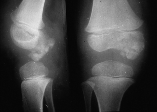 Figure 3. Lateral and anteroposterior radiographs of the knee showing a cloudy structure and exostosis with bone-like density at the medial side of the femur.