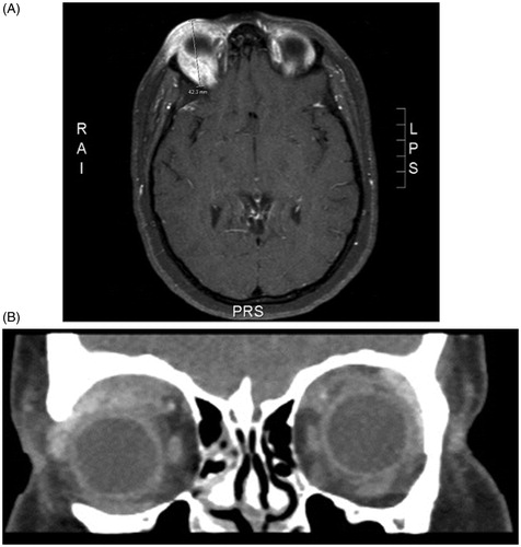 Figure 2.  (A) Right globe proptosis with confluent edema within right extraconal supraorbital soft tissues, extending to posterior one-third of orbit. (B) CT orbit (soft tissue window), showing the mass occupying the right orbital superior space without bone remodeling.