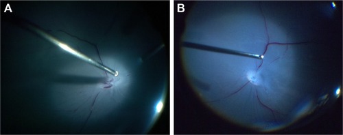 Figure 5 Comparison of surgical field images of pig cadaver eye in vitreoretinal surgery. (A) Images obtained with the prototype 8K microscopic camera and (B) images obtained with the new 8K UHD microscopic camera. Retinal capillary vessels were illuminated by a chandelier endo-illumination fiber.