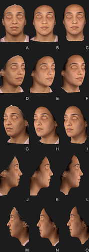 Figure 4 Clinical case 1: 34-year-old woman. In the chin: HAV 1mL was injected with cannula in the subcutaneous layer, while a 0.6 supraperiosteal bolus of HAI was injected with a 27-G needle, close to the inferior border of the chin. A total volume of 1.5mL of CaHA(+) per side was injected in the subcutaneous layer, slightly below the mandible ramus, along its length, while 0.5mL of HAV was injected in the superficial subcutaneous layer along the mandible ramus for further definition. Images taken with Vectra Software at baseline (A, D, G, J, M), after 30 days (B, E, H, K, N) and 90 days (C, F, I, L, O) after the treatment session.