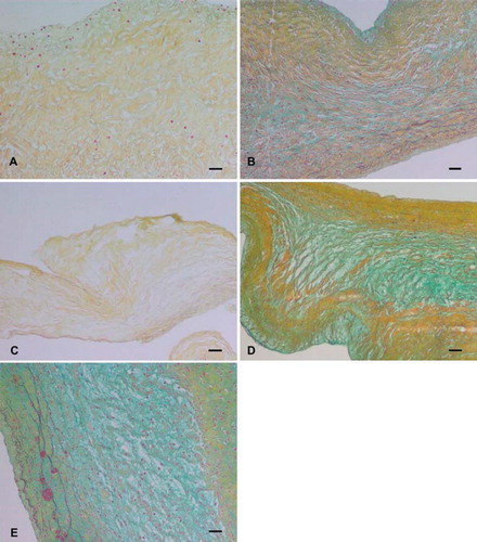 Figure 2. Russel-Movat pentachrome staining of (A) trypsin, (B) osmotic, (C) trypsin-osmotic, (D) detergent-osmotic, and (E) control leaflets. The three-layered structure of the leaflets was preserved in all matrices except those of (A) trypsin and (C) trypsin-osmotic treatments. Trypsin-based treatments resulted in a significant loss of collagen. No elastic fibers or GAGs were detectable. Scale bar 50μm.