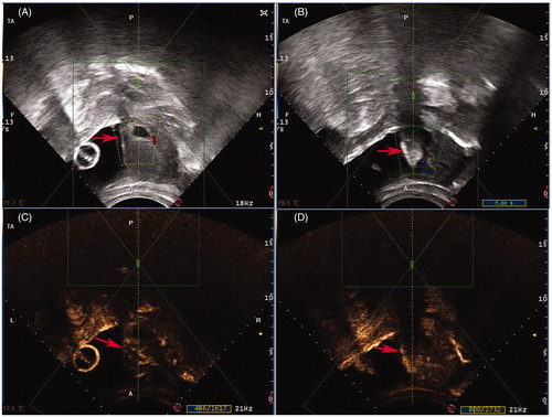 Figure 2. Real-time monitoring ultrasound and contrast enhanced ultrasound images obtained from a patient with CSP before and after HIFU. (A) Pre-HIFU ultrasound image showed a gestational sac (red arrow) embedding in the CSP scar; (B) Real-time ultrasound image showed the significant gray scale change (red arrow) in the embedding area of the CSP scar immediately after HIFU treatment; (C) Pre-HIFU contrast-enhanced ultrasound showed enhancement in myometrium of CSP scar (red arrow) around gestational sac; (D) Post-HIFU contrast-enhanced ultrasound showed no enhancement in myometrium of CSP scar (red arrow).