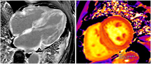 Figure 2. CMR images of an 83-year-old male diagnosed with AL amyloidosis. The left image (Panel A – 4-chamber view) displays the typical distribution of Late Gadolinium Enhancement (LGE), with a prominent subendocardial involvement in the left ventricle and encompassing the walls of all cardiac chambers, including the interatrial septum. In the right image (Panel B), native T1 mapping acquisition (transverse plane) reveals an elevated measurement within the interventricular septum, registering at 1448 milliseconds. This value exceeds the recommended threshold, which should ideally be below 1371 milliseconds, their upper normal value is defined as mean + 2 standard deviations (SD).