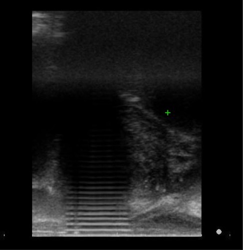 Figure 1 Image shows artifact caused by stool stored in the rectum and interfered with the image quality. The examiner cannot easily measure the prostate sagittal length.