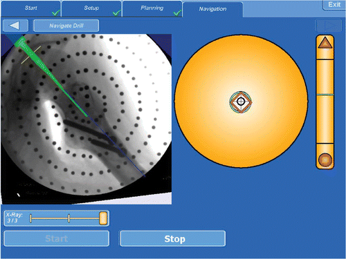 Figure 4. Left: Virtual representation of the tracked pin trajectory superimposed on an acquired X-ray image. Right: Two different points of the tracked pin trajectory in cross-hair representation. [Color version available online.]