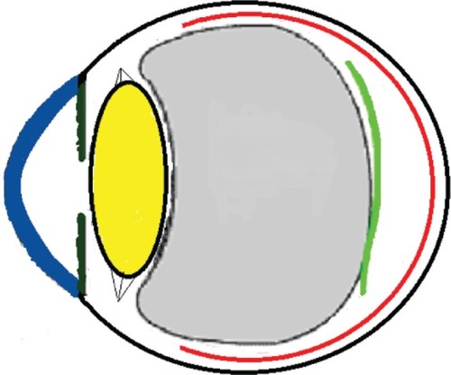 Figure 11 Schematic drawing of an adult eye with spontaneous epiretinal membrane (ERM) separation following acute posterior vitreous detachment.