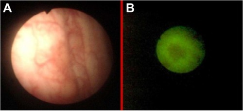 Figure 10 Recurrence of transition cell cancer in white light cystoscopy (A) and fluorescence (B) imaging.