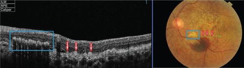 Figure 5 Fundus photograph (right) showing two different types of deposit: exudates (blue rectangle) and drusen (red arrow) in the left eye of a patient with wet ARMD; the B-scan line on the fundus photograph has the same width as the B-scan SD-OCT image (left).