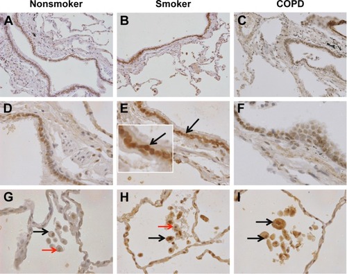 Figure 3 aSMase labeling in human lung tissue.Notes: Representative images for aSMase expression (brown) within the peripheral lung tissue from (A, D, G) NS, (B, E, H) S, and (C, F, I) COPD patients. aSMase was detected within the small airway epithelium (A–F) with a pronounced nuclear expression (inset arrow). aSMase was also detected within the alveolar macrophages and alveolar walls (G–I). aSMase-positive alveolar macrophages (black arrows) observed near alveolar macrophages lacking nSMase-2 expression (red arrows). Magnification ×200 (A–C) ×600 (D–I).Abbreviations: NS, nonsmoker; S, smoker.