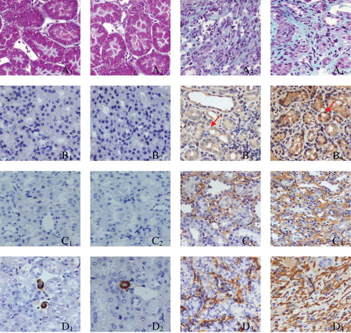 Figure 2. Tissue parameters in two groups.Notes: Masson staining for SHO group (A1, 14th day; A2, 28th day) and GU group (A3, 14th day; A4, 28th day). Representative samples of immunohistochemical staining for PAX2 (SHO, B1, 14th day, B2, 28th day; GU, B3, 14th day, B4, 28th day); TGF-β1 (SHO, C1, 14th day, C2, 28th day; GU, C3, 14th day, C4, 28th day); α-SMA (SHO, D1, 14th day, D2, 28th day; GU, D3, 14th day, D4, 28th day); Col-IV (SHO, E1, 14th day, E2, 28th day; GU, E3, 14th day, E4, 28th day); FN (SHO, F1, 14th day, F2, 28th day; GU, F3, 14th day, F4, 28th day); caspase-3 (SHO, G1, 14th day, G2, 28th day; GU, G3, 14th day, G4, 28th day); and cell apoptosis (SHO, H1, 14th day, H2, 28th day; GU, H3, 14th day, H4, 28th day) were observed in two groups. PAX2 and caspase-3 were also mainly located in the RTEC (red arrow for PAX2 and blue arrow for caspase-3), and the apoptotic cell in our observation was mainly derived from RTEC (black arrow). PAX2, paired box 2; TGF-β1, transforming growth factor-β1; α-SMA, α-smooth muscle actin; Col-IV, collagen-IV; FN, fibronectin; RTEC, renal tubular epithelial cells; SHO, sham operation group; GU, model group subjected to unilateral ureteral obstruction. Magnification ×400.