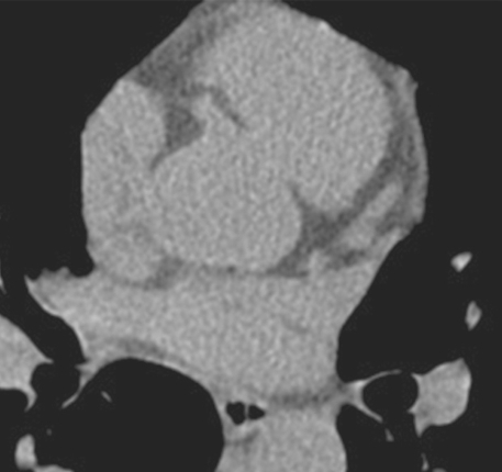 Figure 2 56-year-old male with family history of heart disease, found to have no coronary calcification. This person was subsequently not treated with statin therapy, after being assessed as low risk by CT imaging.
