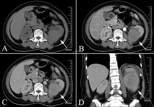 Figure 2. Preoperative Contrast-enhanced CT, the tumor was indicated by the arrows. (A) transverse plane (B) arterial phase (C) venous phase (D) Coronal plane.