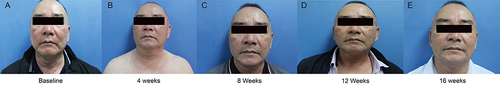 Figure 1 Significant improvement with the use of dupilumab before (A) after administration for 4 weeks (B), 8 weeks (C), 12 weeks (D), and 16 weeks (E) in the same patient.