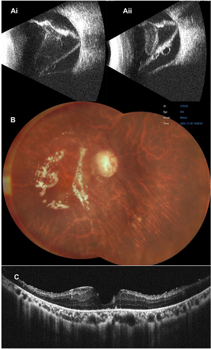 Figure 4 Long term follow-up in a 36 years-old man with complex retinal detachment in his right eye. (Ai and Aii) preoperative ocular ultrasonography: retinal detachment with advanced proliferative vitreoretinopathy. Visual acuity was 2.3 logMar (B and C) Postoperative fundus photography and optical coherence tomography after 28 mois: retinal reattachment under silicone oil prolonged tamponade. Visual acuity improved to 1 logMAR. Silicone oil was not removed because the patient was unwilling to undergo further surgeries.